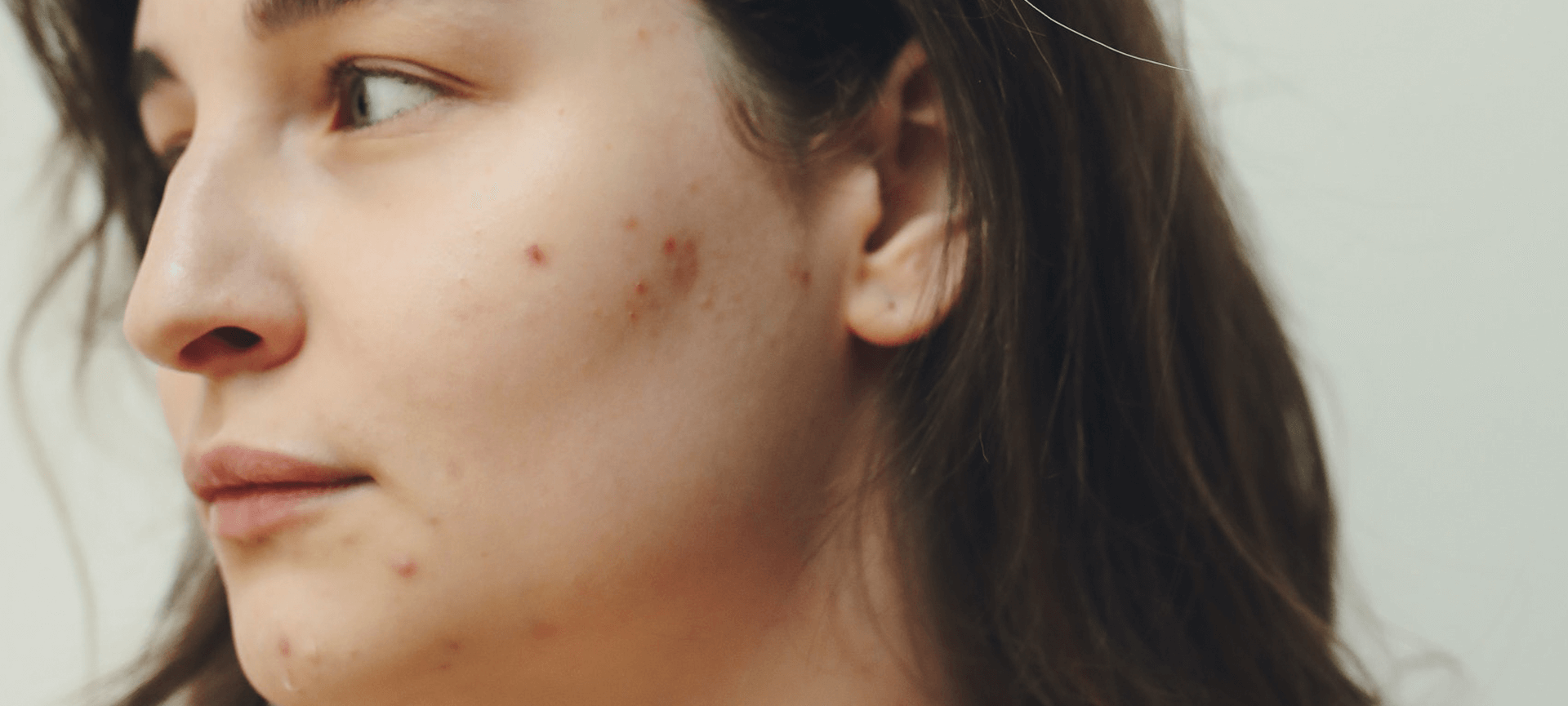 Resista, não esprema as espinhas: como amenizar a acne